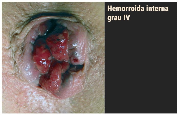 Hemorroida interna grau IV