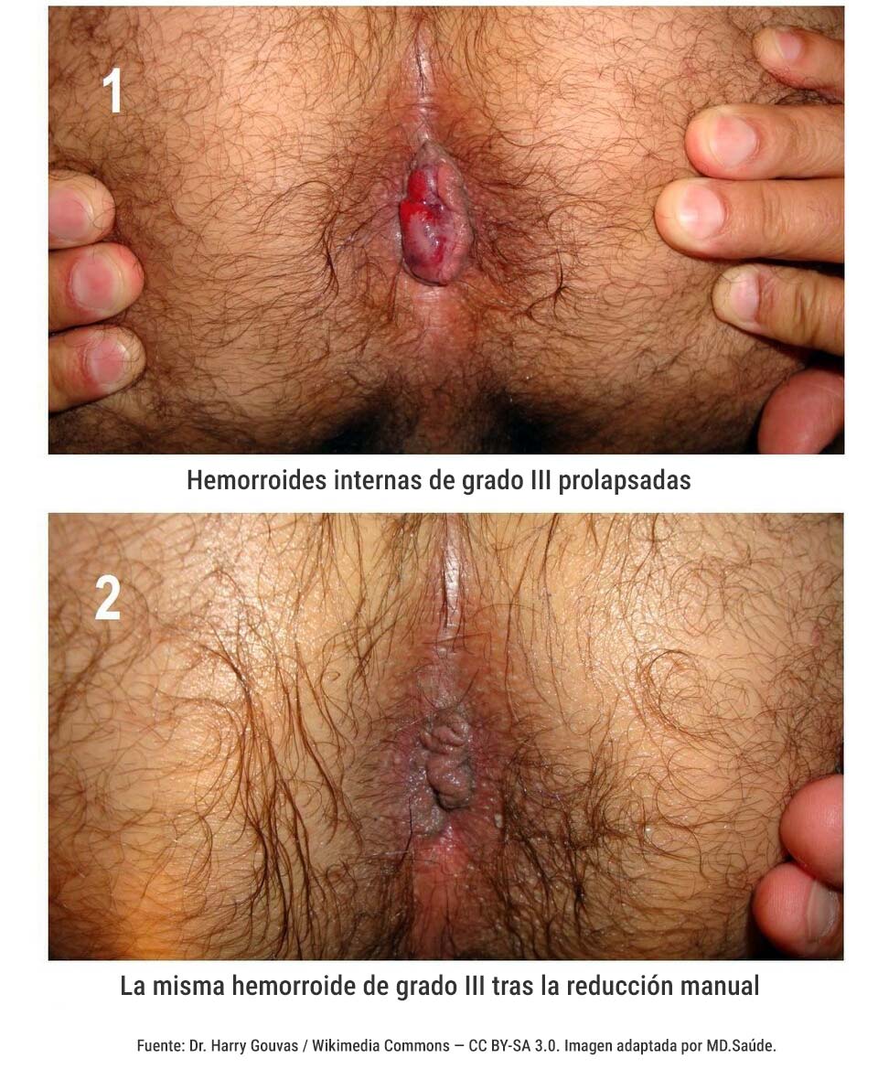 Hemorroide interna de grado III antes y después de la reducción manual.