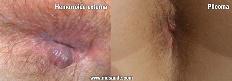 Hemorroide externa y plicoma