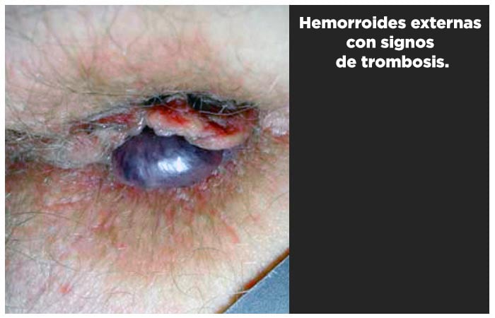 Hemorroides externas con signos de trombosis.