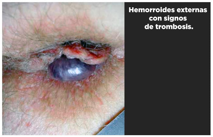 hemorroides-foto5.jpg