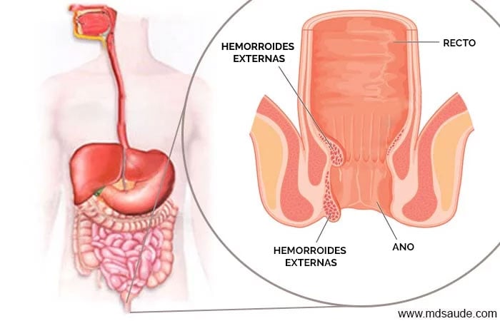 Hemorroides externas y internas