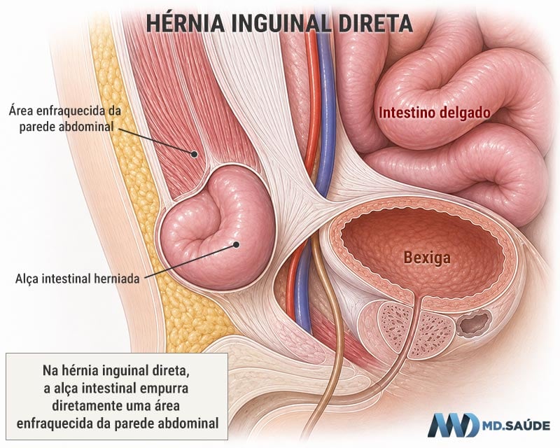 Hérnia inguinal direta