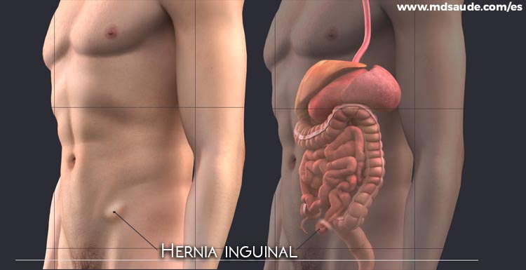 Hernia inguinal