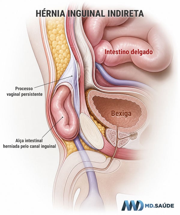 Hérnia inguinal indireta