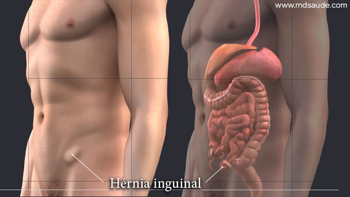 HERNIA ABDOMINAL - DR PABLO HÜBNER - CIRURGIAS