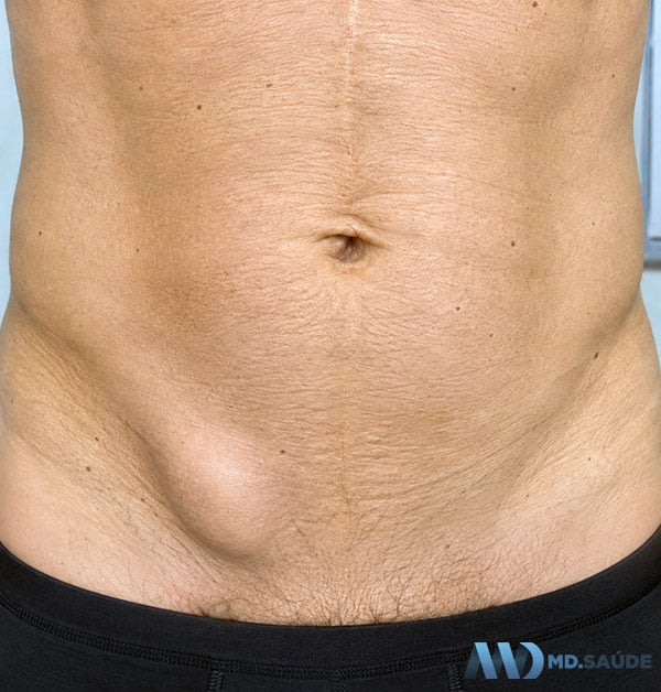 Protuberância da hérnia inguinal