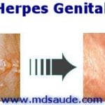 HERPES GENITAL – Síntomas y Tratamiento