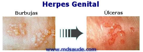 herpes genital: burbujas y úlceras