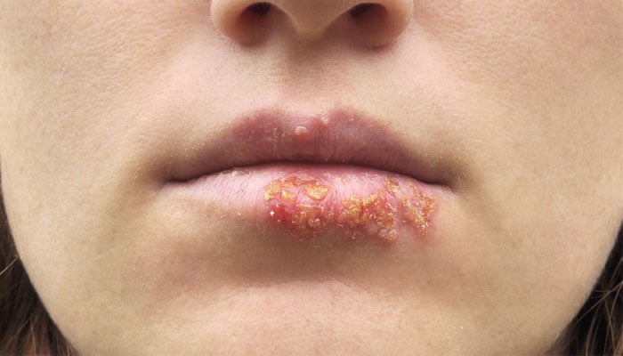 Herpes labial