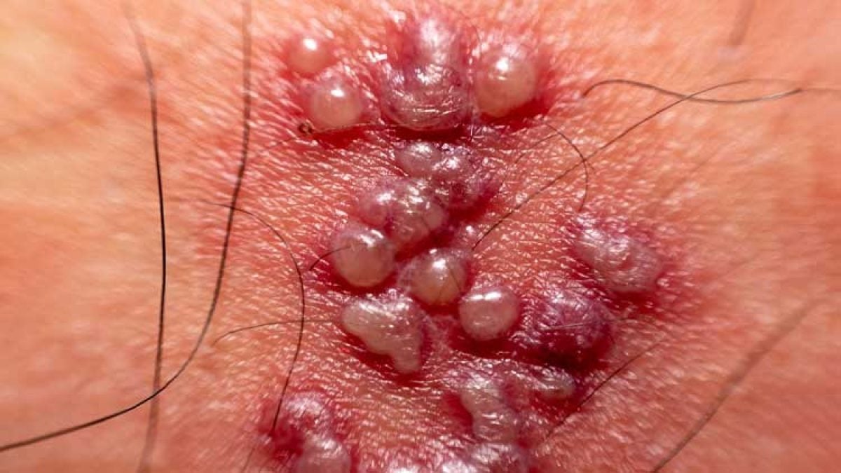FOTOS: Herpes Genital em Homens