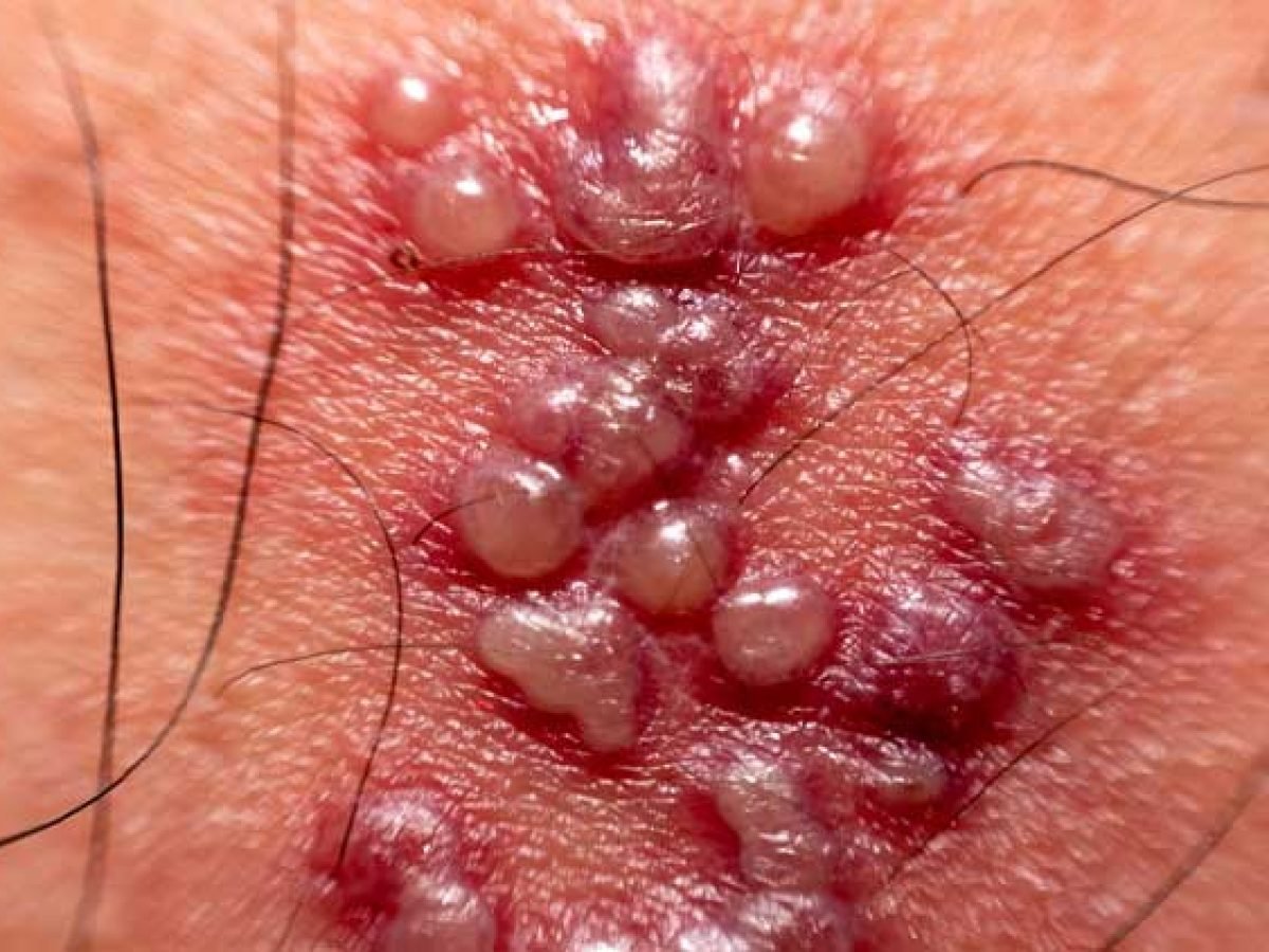 FOTOS: Herpes Genital em Homens