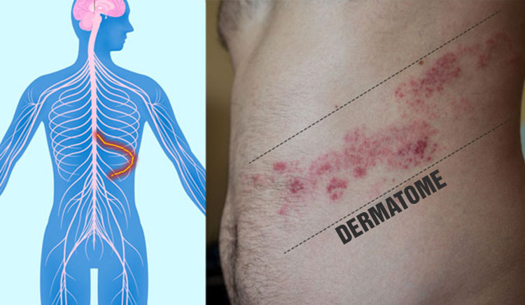 Herpes Zoster Dermatomes Figure 1 From Herpes Zoster Virus An Unusual