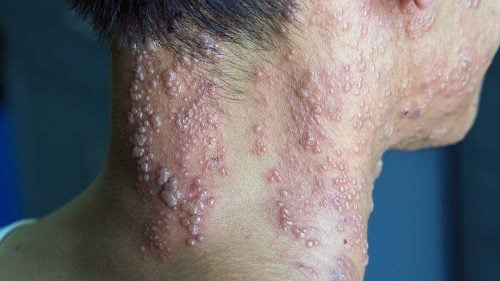 Pictures of shingles (herpes zoster)
