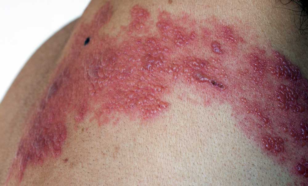 Mild Shingles Rash On Face