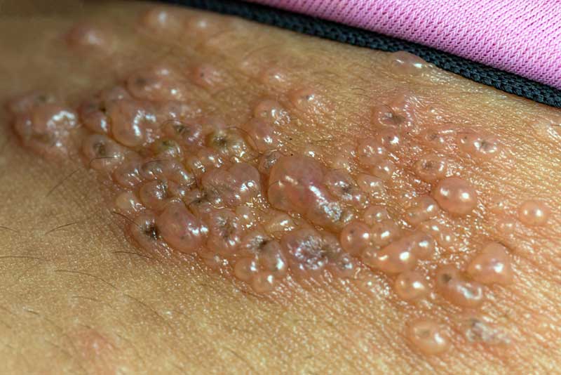 Herpes zoster em close