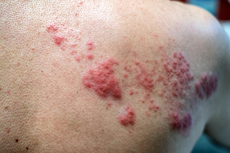 herpes zoster nas costas
