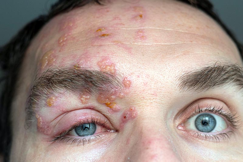 herpes zoster na face