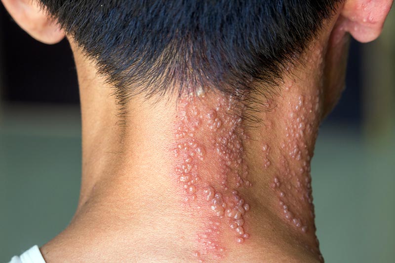 herpes zoster no pescoço