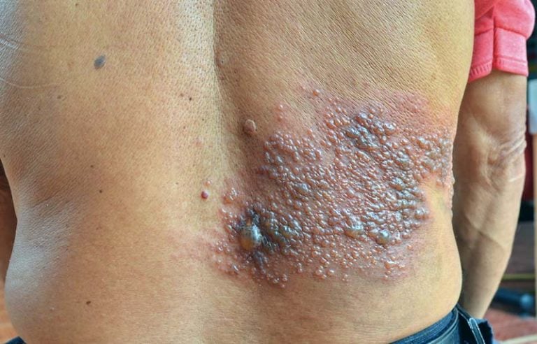 Fotos de herpes zoster (cobreiro) MD.Saúde