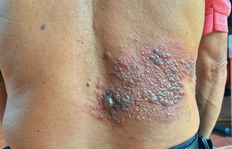 herpes zoster nas costas