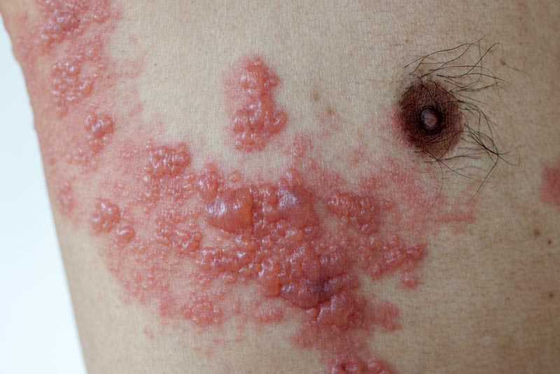 herpes zoster no peito