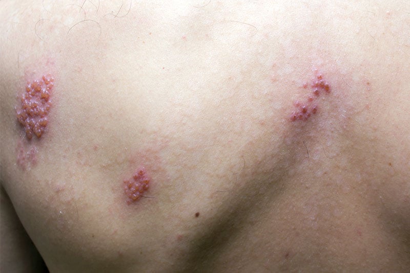 herpes zoster nas costas