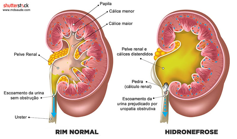 hidronefrose