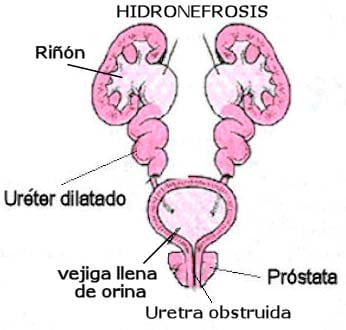hidronefrosis