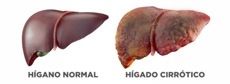 Hígado normal y hígado cirrótico con múltiples nódulos