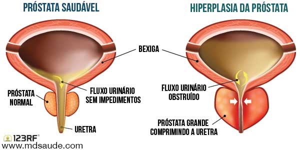 Hiperplasia da próstata