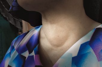 HIPOTIROIDISMO – Tiroiditis de Hashimoto