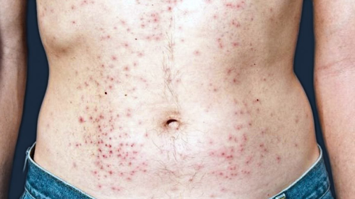 FOTOS: Lesões de Pele Provocadas pelo HIV