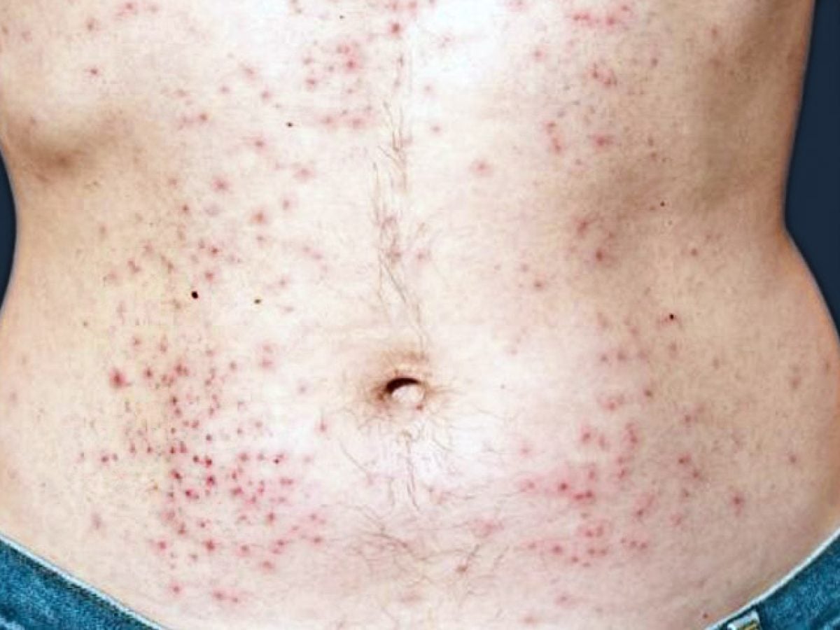 FOTOS: Lesões de Pele Provocadas pelo HIV