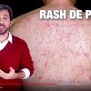 VÍDEO: Primeiros Sintomas do HIV