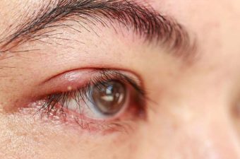 ORZUELO – Causas, síntomas y tratamiento