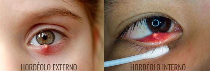 Terçol ou hordéolo: o que é isso? - Saúde dos Olhos > AbcMed