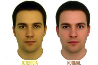 Síndrome de Gilbert, Crigler-Najjar e Dubin-Johnson