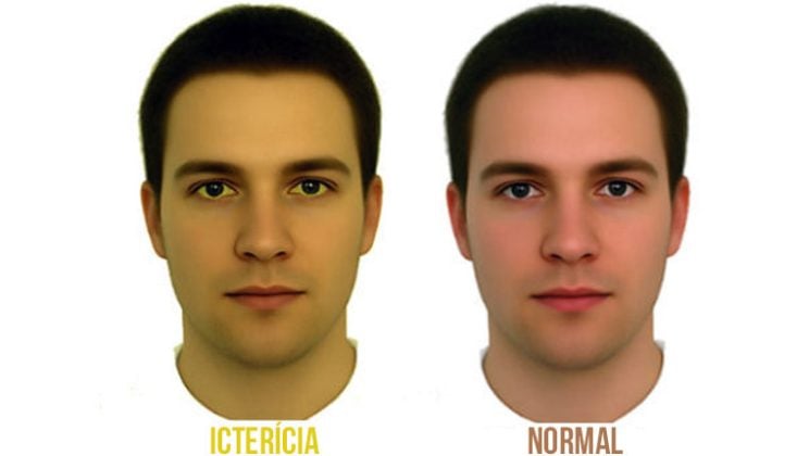 Ictericia