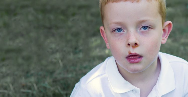 Impetigo