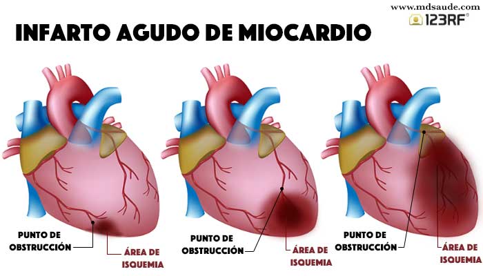 Tamaño de la lesión del miocardio