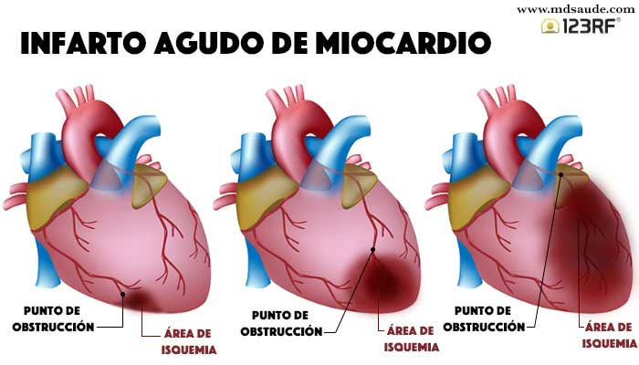 infarto agudo del miocardio