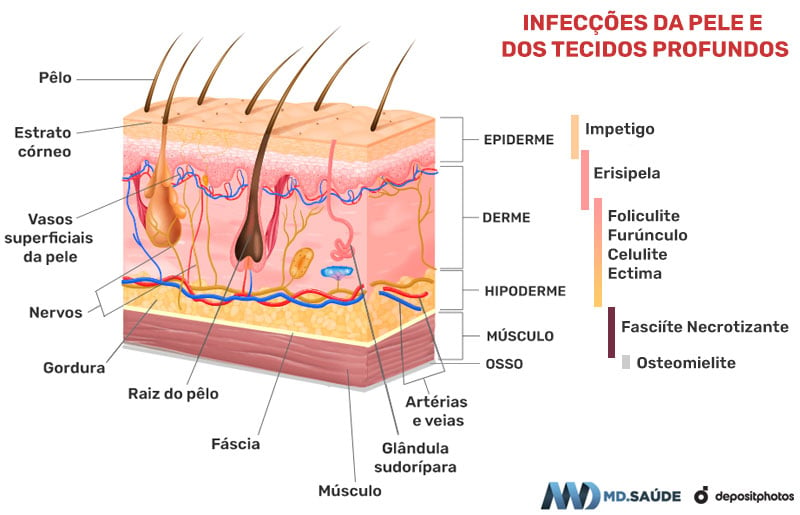 Infecções da pele conforme sua profundidade: foliculite, impetigo, furúnculo, erisipela, celulite, ectima, abscessos, fasciíte necrotizante e osteomielite.
