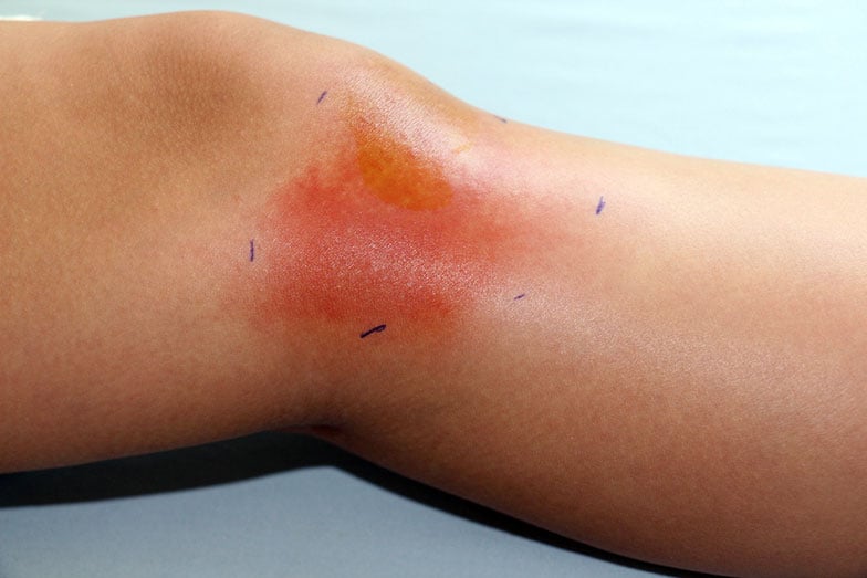 Inflamação.