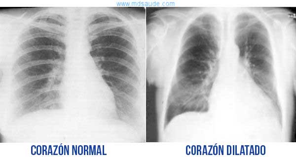 Radiografía de tórax con agrandamiento del corazón