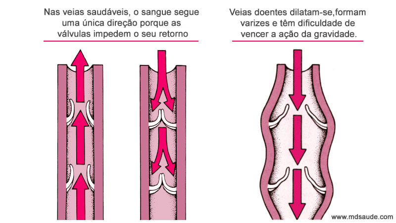 varicoza continua