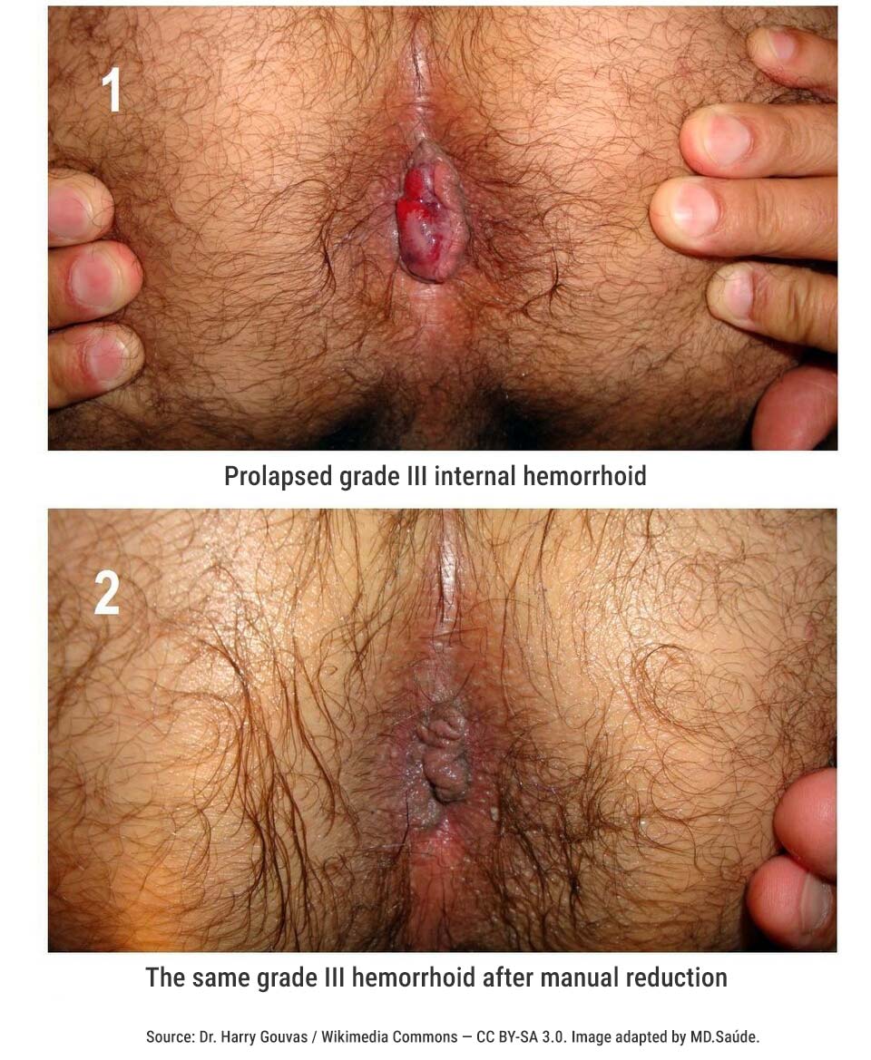Grade III internal hemorrhoid before and after manual reduction.