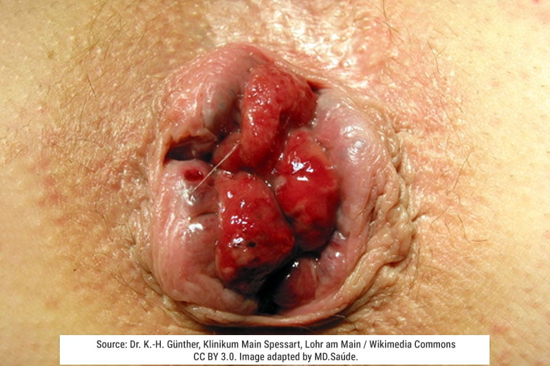 Grade III internal hemorrhoids — in this case, the prolapse could still be reduced manually.