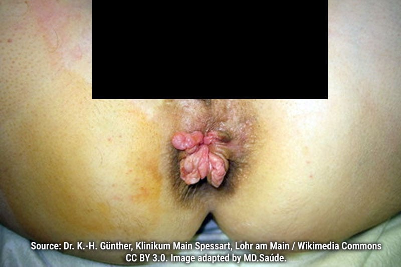 Grade IV internal hemorrhoids