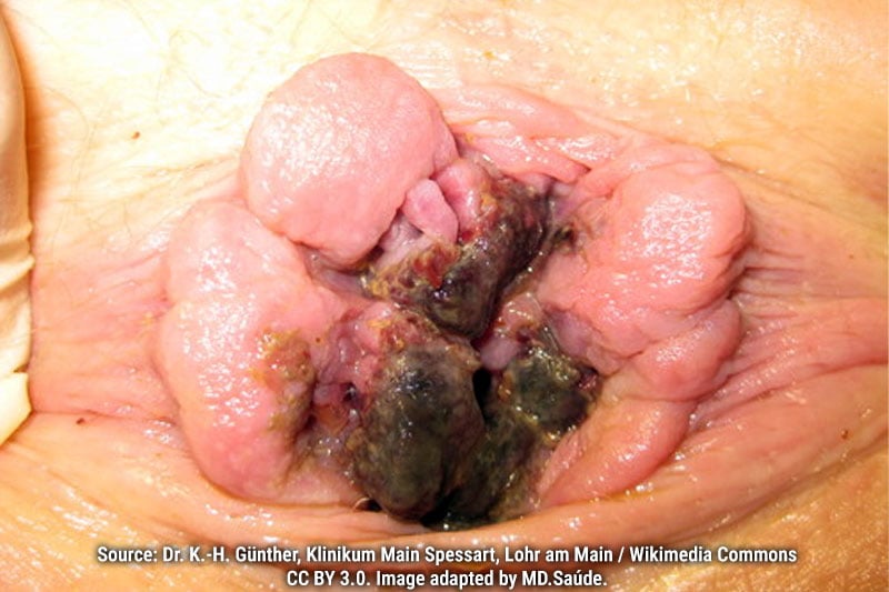 Thrombosed grade IV internal hemorrhoids with signs of tissue necrosis.